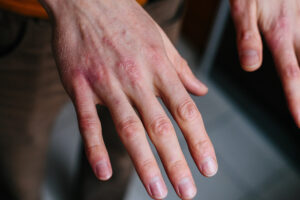 אקזמה אסתמה של העור בכפות הידיים